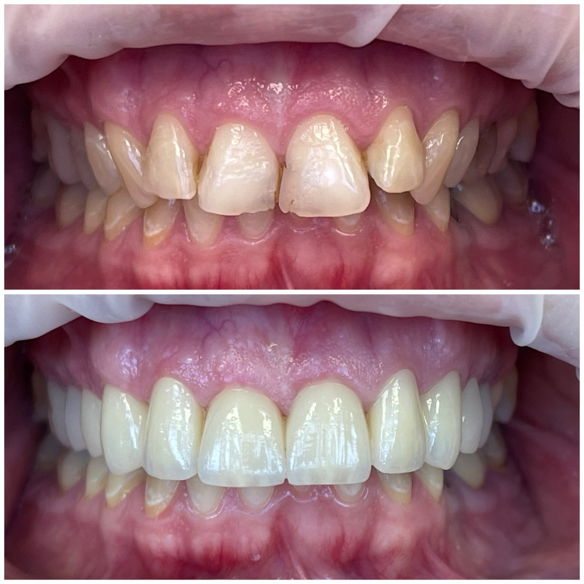 Antes y después de carillas Hollywood Smile en Rosental Dental – transformación visible de la sonrisa