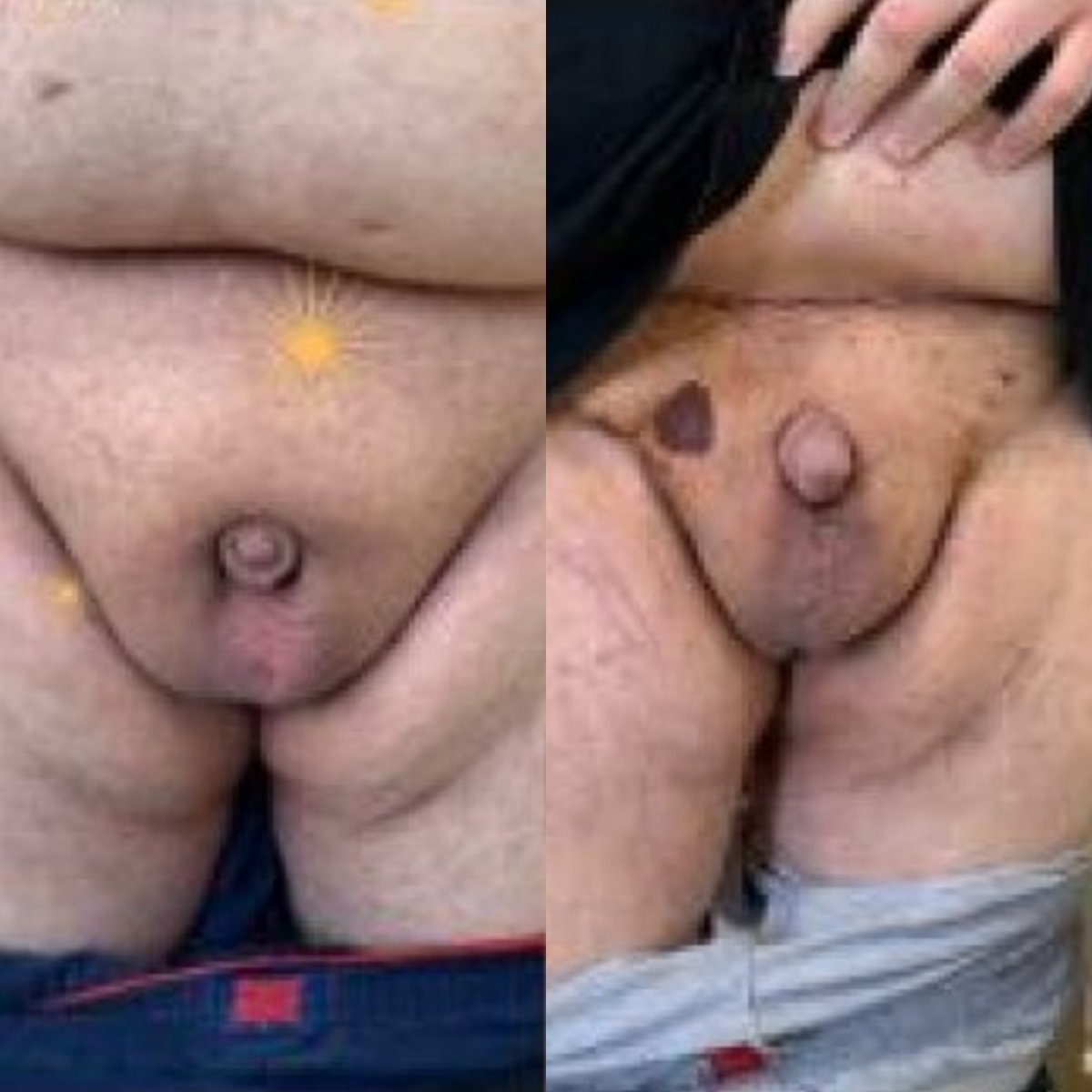 Resultados antes y después de aumento de pene en Uroaesthetic, mejora visible del tamaño