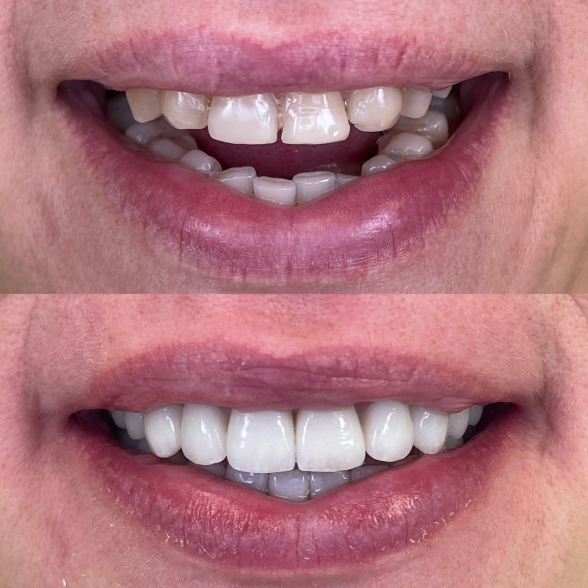 Antes y después de Hollywood Smile en Rosental Dental: transformación de sonrisa con carillas