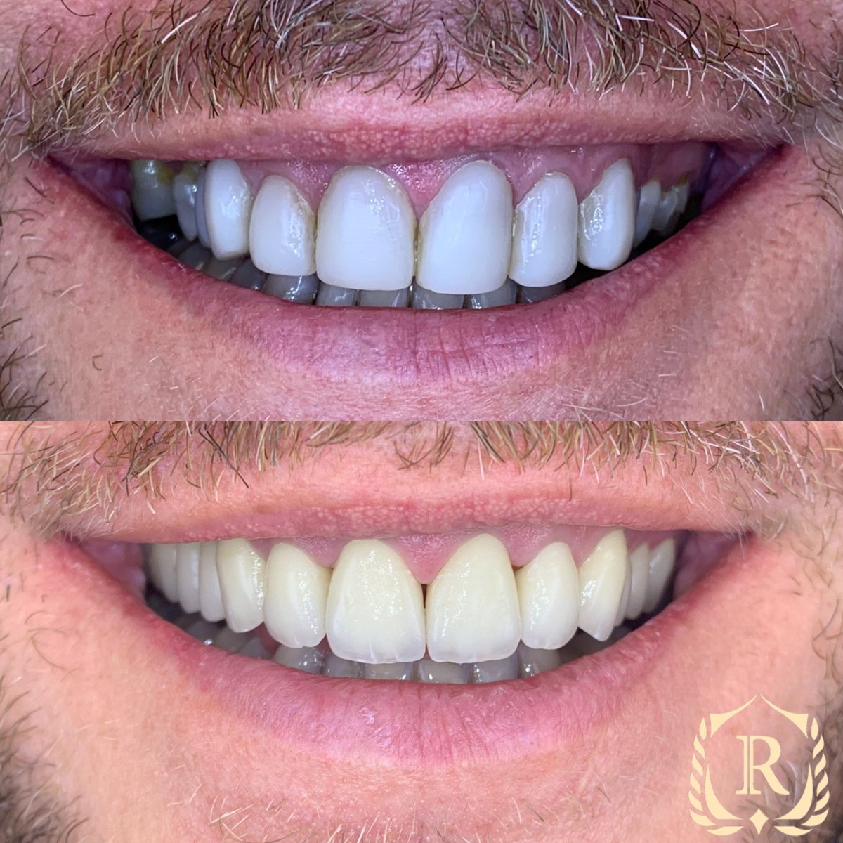 نتائج قبل وبعد ابتسامة هوليوود في Rosental Dental – تحسين جمالية الأسنان