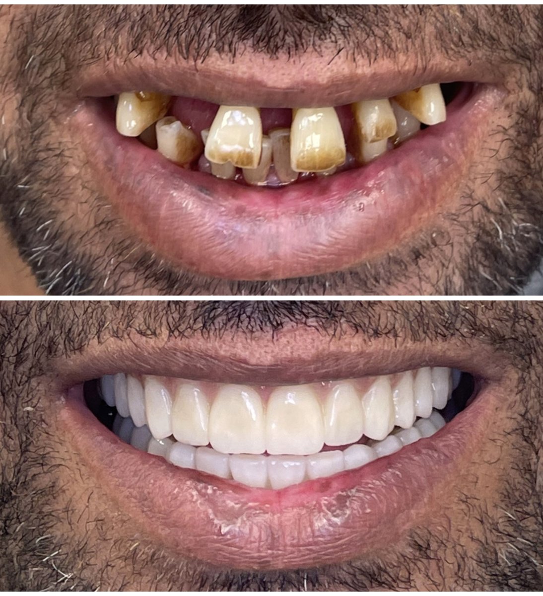 Résultat avant/après implants All-on-6 chez Rosental Dental – restauration complète du sourire