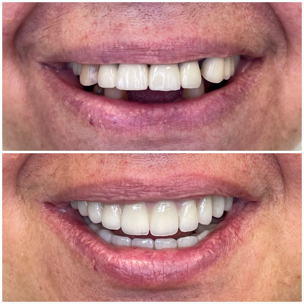 Resultados antes y después de implantes All-on-6 en Rosental Dental – sonrisa restaurada