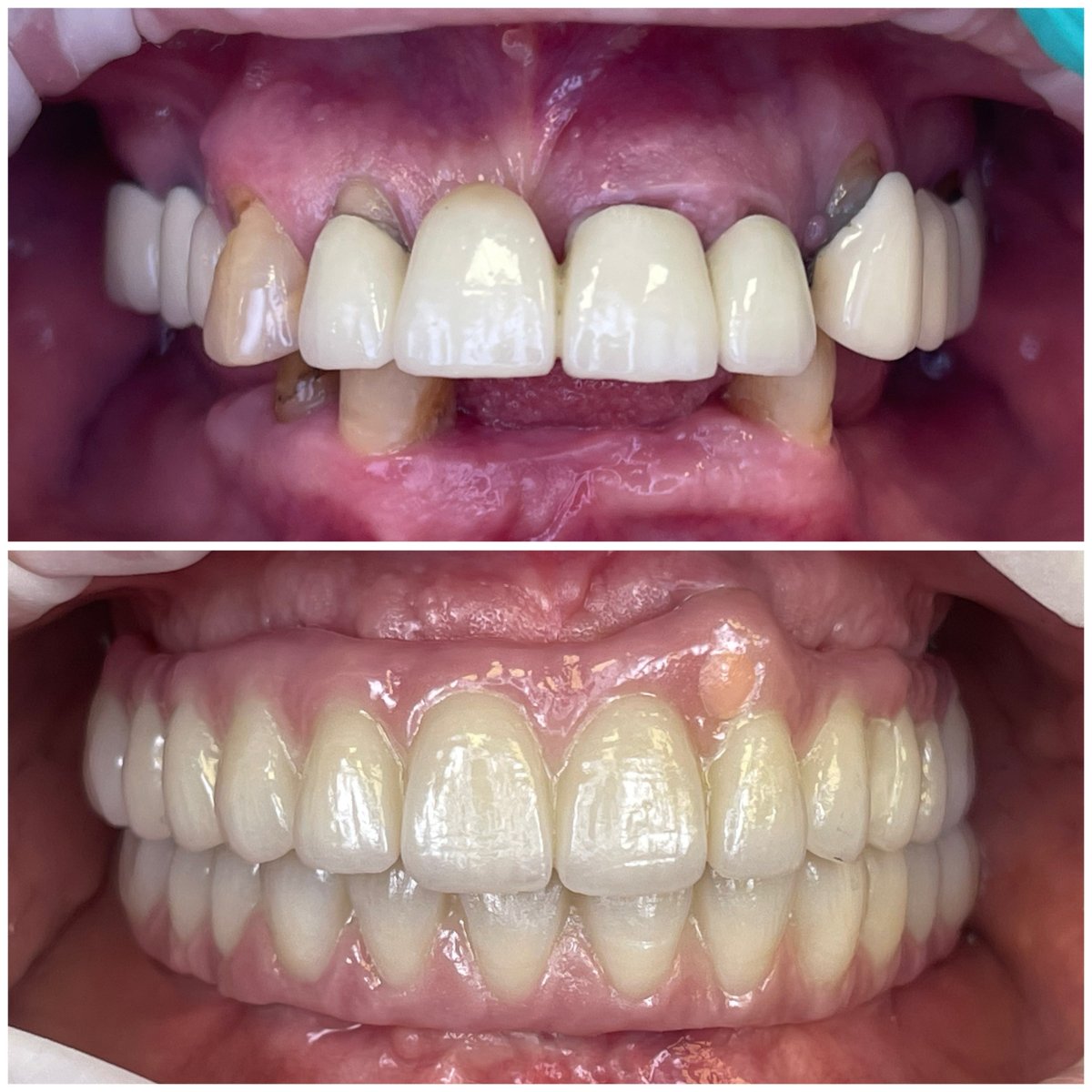 Resultados antes y después de implantes dentales All-on-6 en Rosental Dental – sonrisa restaurada