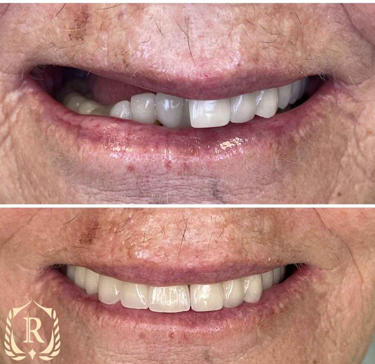 Antes y después de implantes dentales All-on-6 en Rosental Dental, sonrisa mejorada