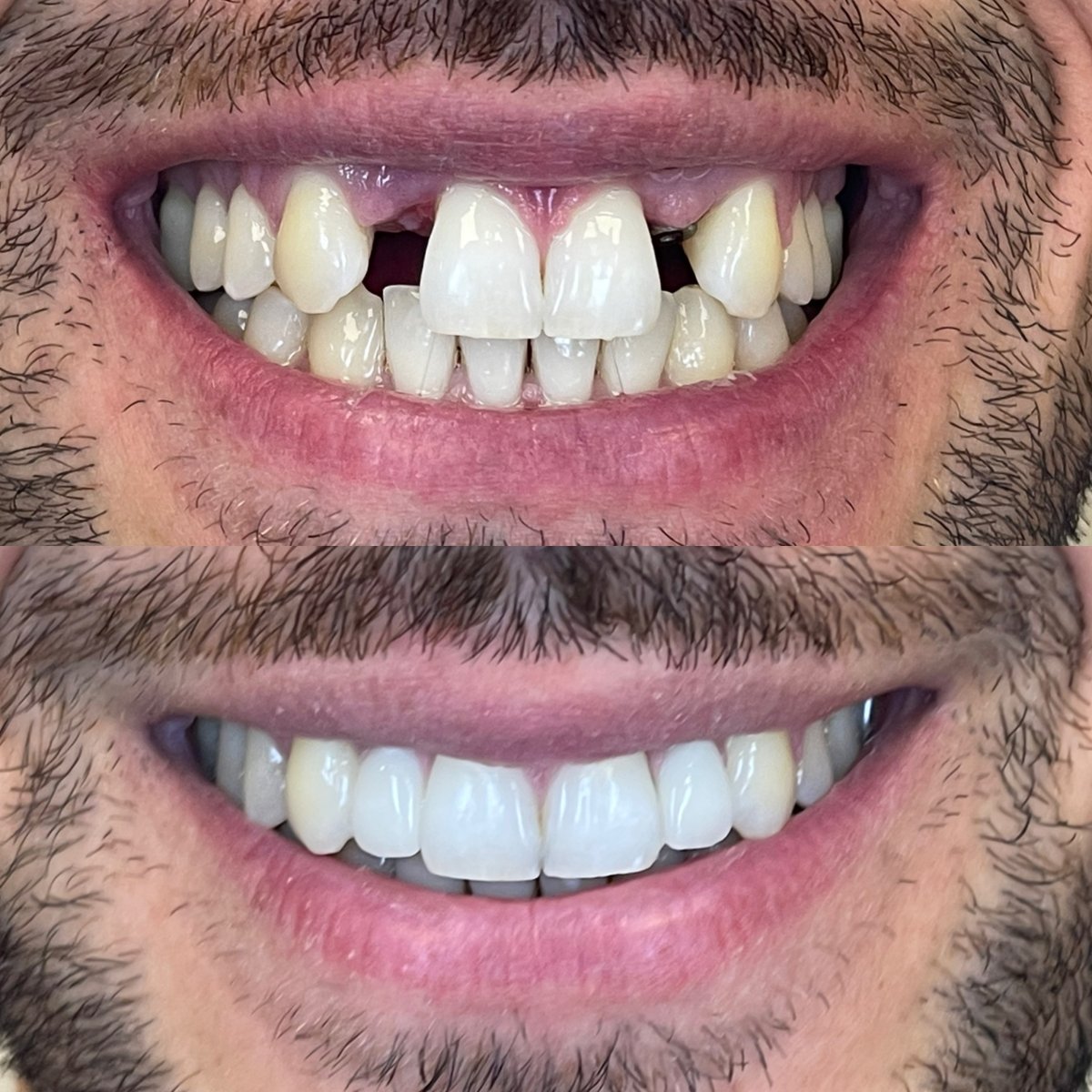 Resultados antes y después de implantes All-on-6 en Rosental Dental: sonrisa restaurada