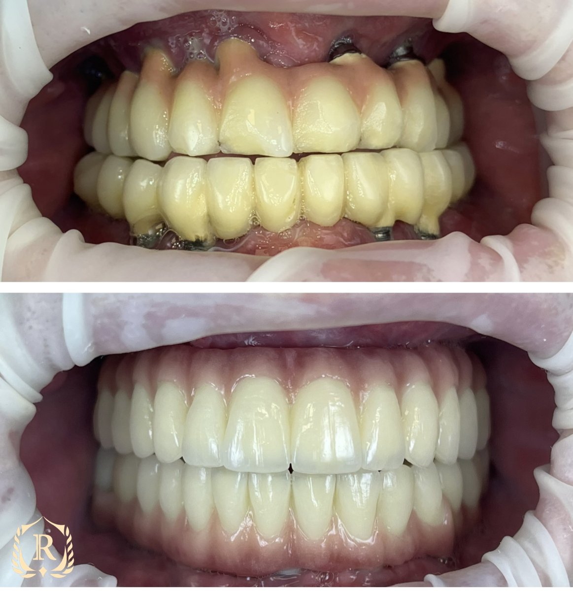 نتائج قبل وبعد زراعة الأسنان All-on-6 في Rosental Dental – استعادة الابتسامة الكاملة