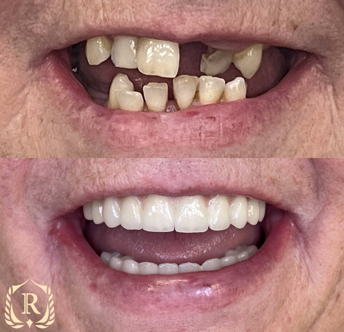 Resultados antes y después de implantes All-on-6 en Rosental Dental – restauración total de sonrisa