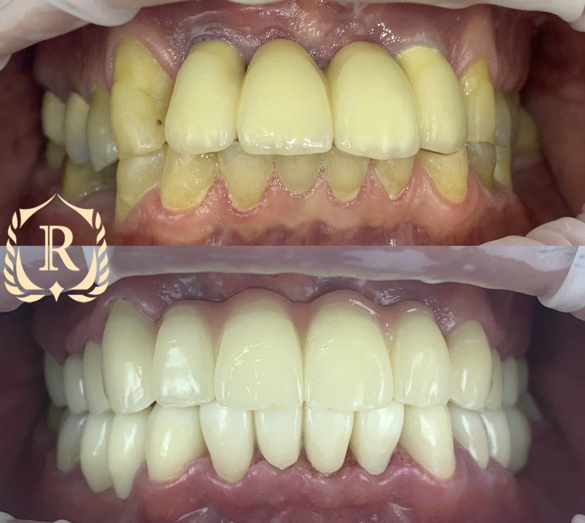 Resultados antes y después de implantes All-on-4 en Rosental Dental – restauración total de sonrisa
