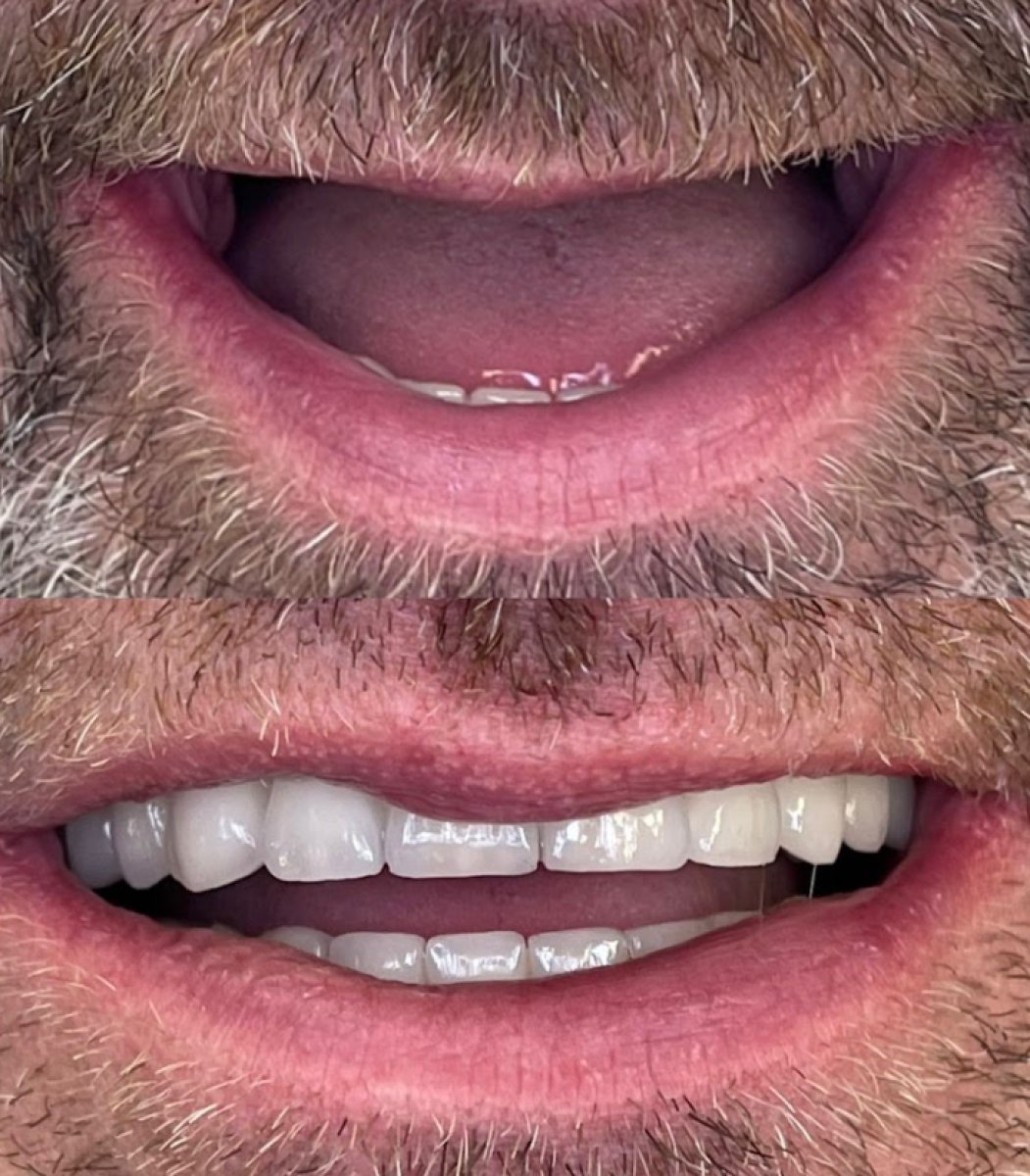 Resultados antes y después de implantes All-on-4 en Rosental Dental – restauración de sonrisa