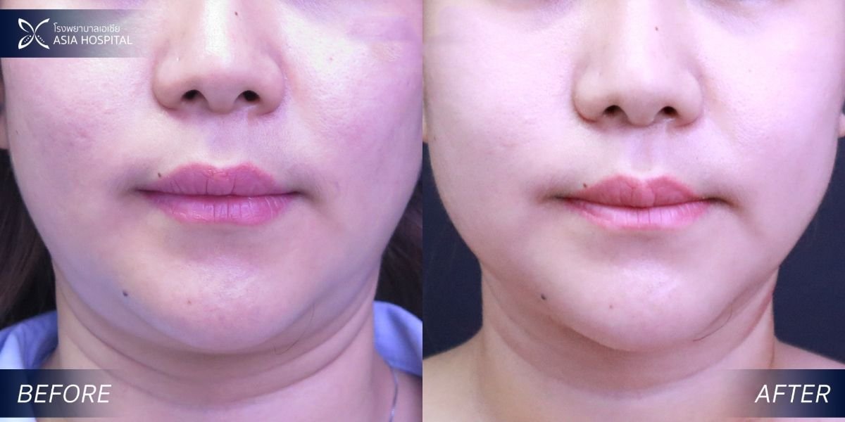 Before and after double chin liposuction result at Asia Cosmetic Hospital, improved jawline contour