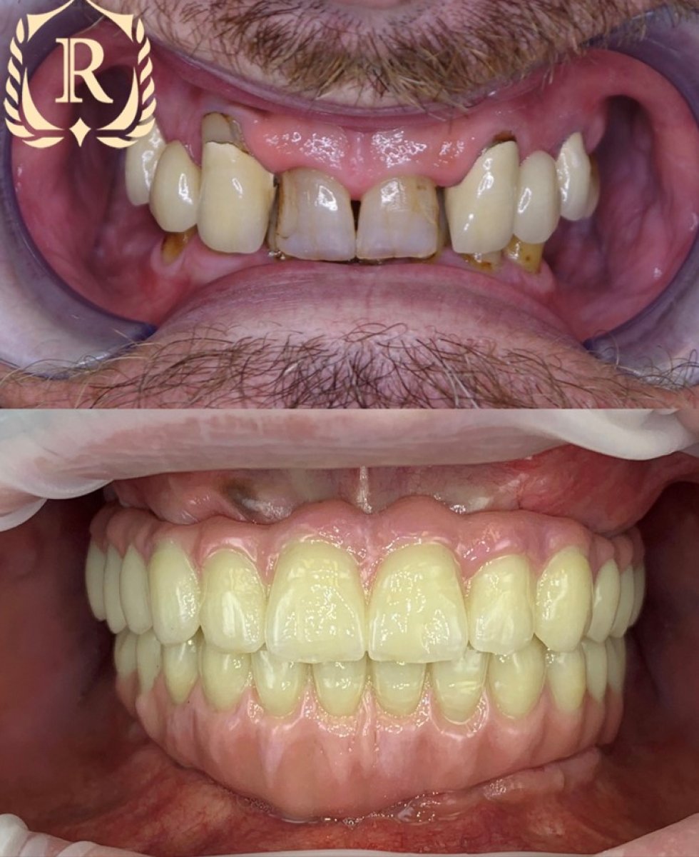 Resultados antes y después de implantes All-on-4 en Rosental Dental – restauración total de sonrisa