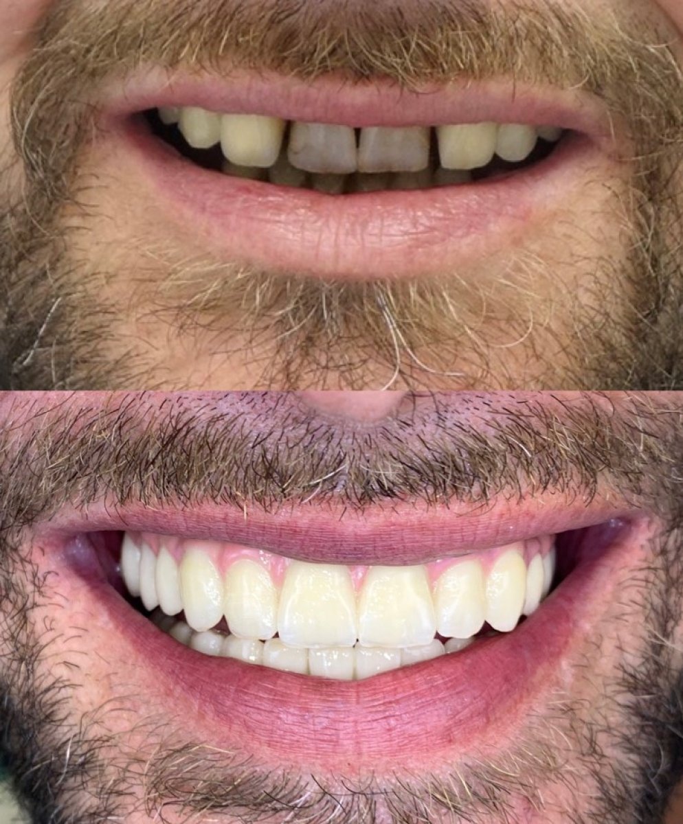 Antes y después de implantes dentales All-on-4 en Rosental Dental – sonrisa mejorada