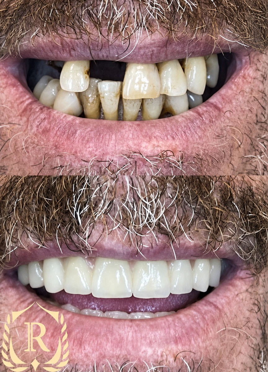 Resultado antes y después de implantes All-on-4 en Rosental Dental: sonrisa restaurada