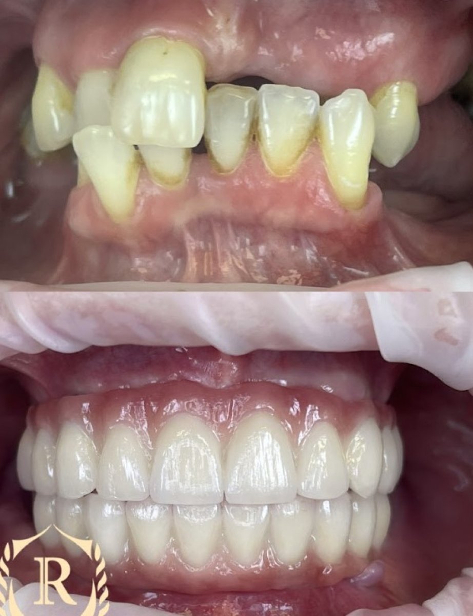 Antes y después de implantes dentales All-on-4 en Rosental Dental – restauración total de sonrisa