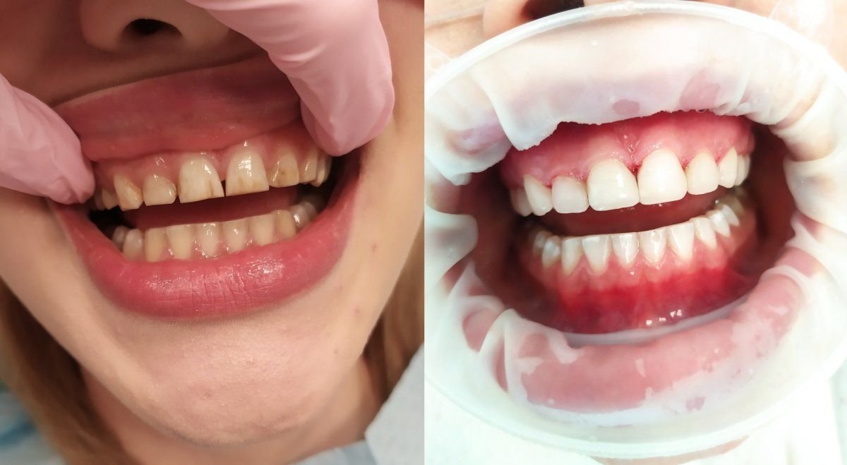 Результаты до и после реставрации зубов в Smile Dentica Clinic – улучшенный вид зубов