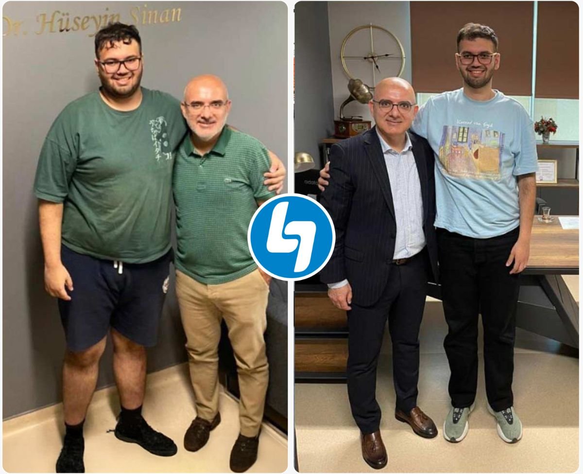 Stomach resection before and after results at Lokman Hekim Istanbul Hospital, weight loss visible