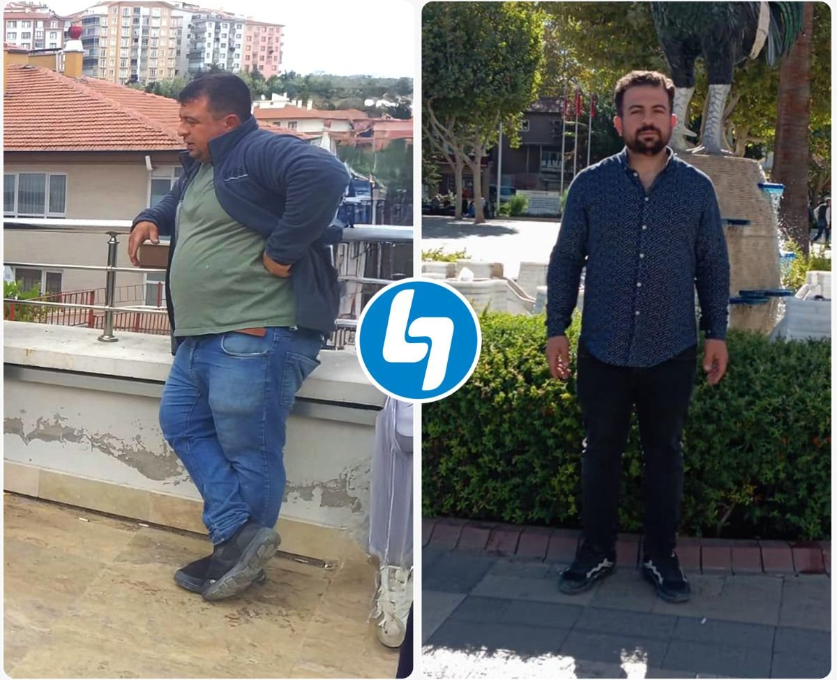 Antes y después de resección gástrica en Lokman Hekim Istanbul Hospital, resultado visible de pérdida de peso