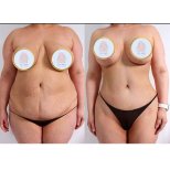 Before and after Breast augmentation photos by Dr. 