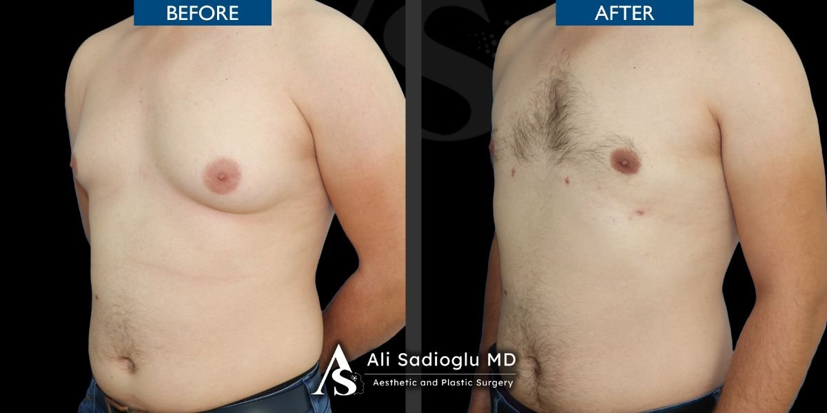 Resultados antes y después de ginecomastia en Dr. Safa Manav Clinic, contorno masculino