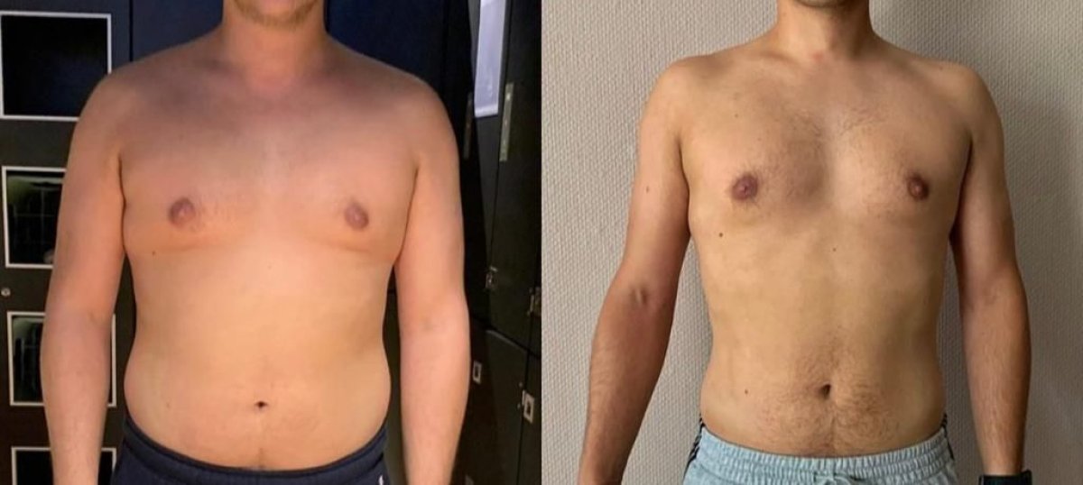 نتائج قبل وبعد جراحة التثدي في عيادة Dr. Safa Manav، تحسين شكل الصدر