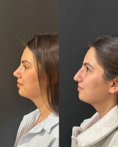 Premium Rhinoplasty (nose job) - photo 4