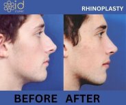 Fotos vor und nach Rhinoplastik (Nasenkorrektur) durch Dr. Dr Phatcharasak Kraisornphongsakul Md