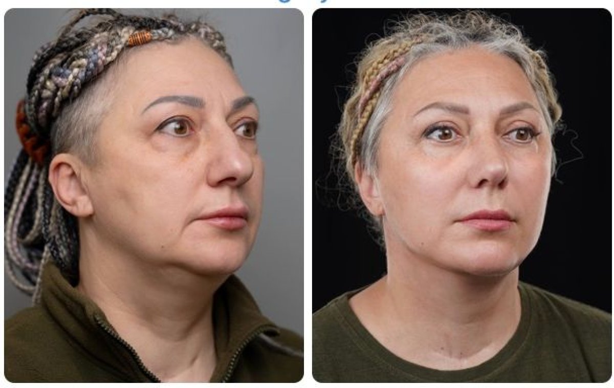Résultats avant et après lifting chez Yurchenko Plastic Surgery Team Kyiv, visage raffermi