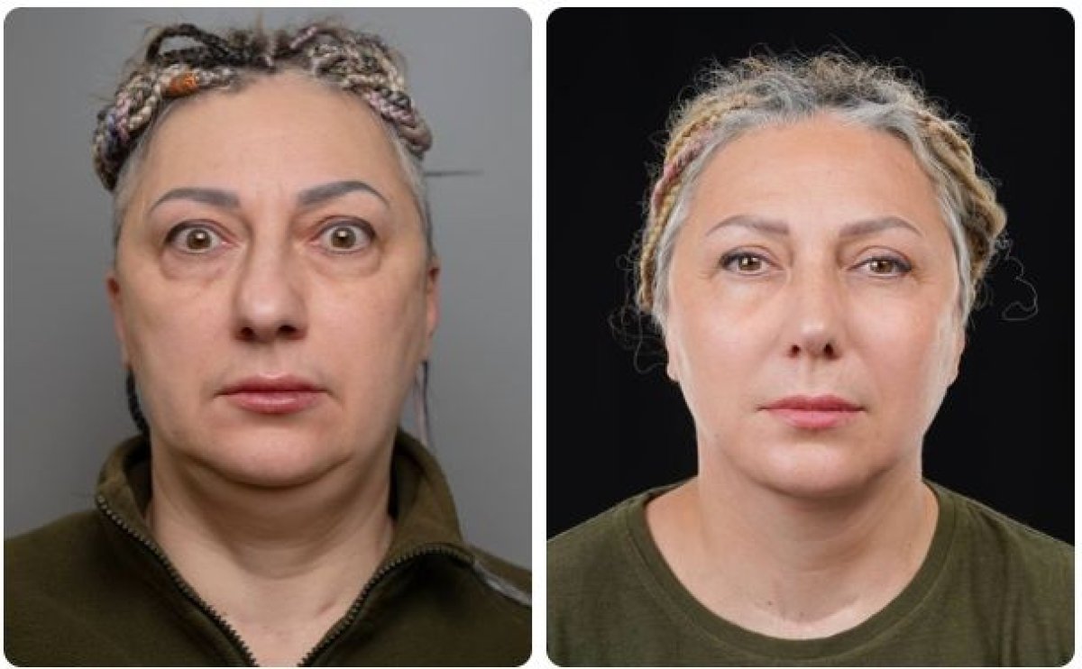 Результаты до и после подтяжки лица в Yurchenko Plastic Surgery Team Kyiv, омоложение