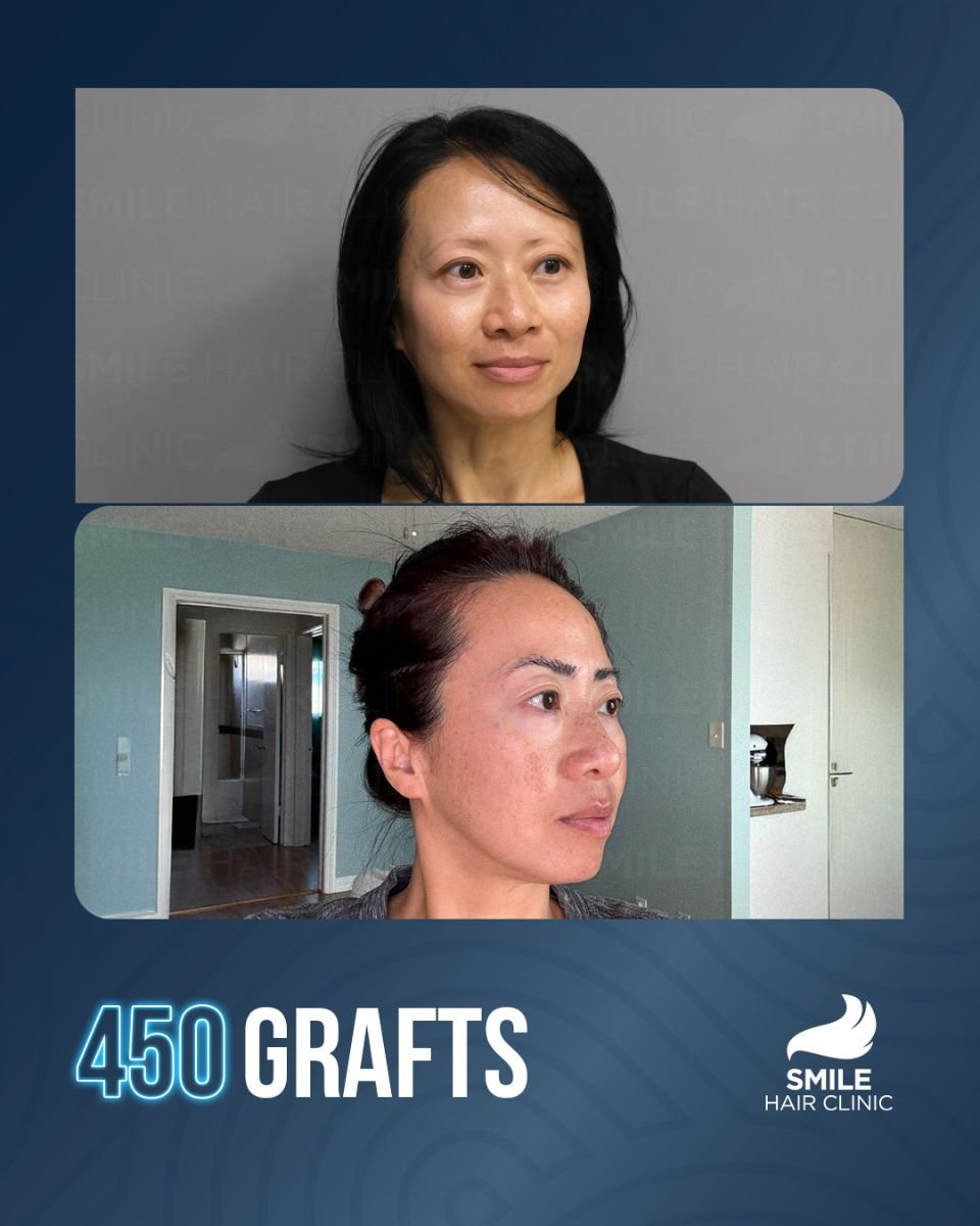 نتيجة زراعة الحواجب 450 طعماً قبل وبعد في Smile Hair Clinic تركيا