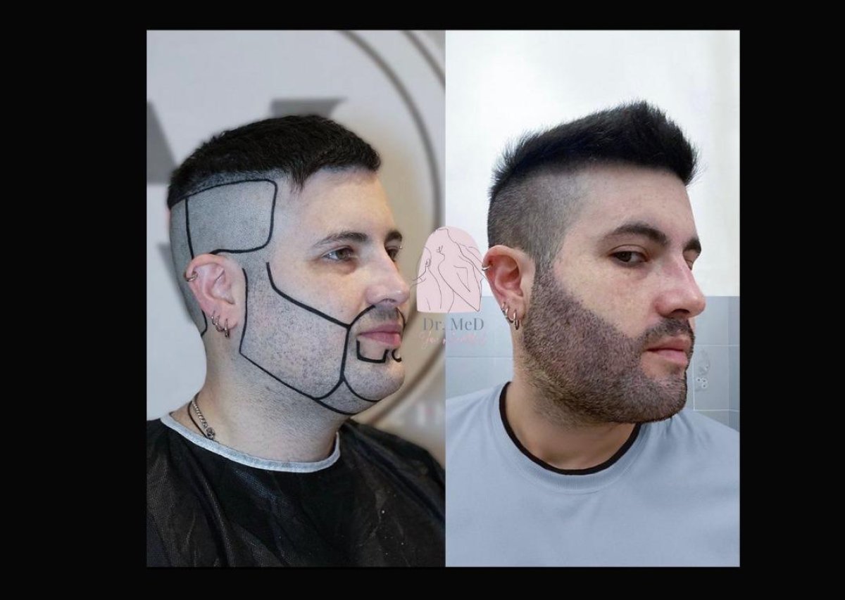 Resultados de trasplante de barba antes y después en Dr. MED – barba más densa y definida