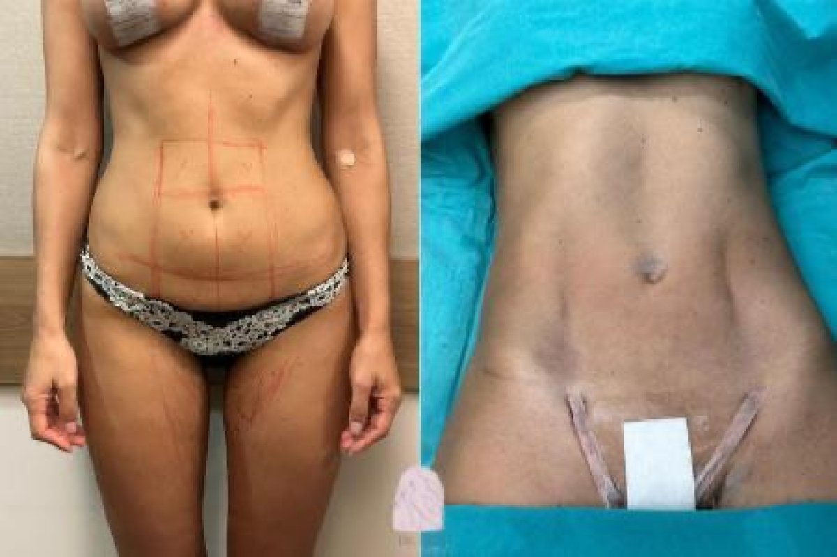 نتائج نحت الجسم قبل وبعد في Dr. MED – تحسين واضح في شكل البطن