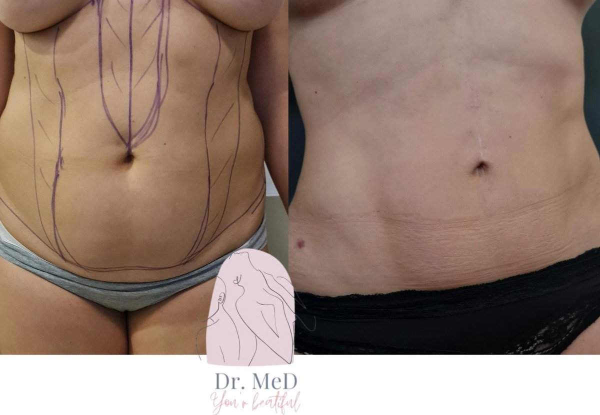 Before and after liposculpture results at Dr. MED, visible abdominal contour improvement