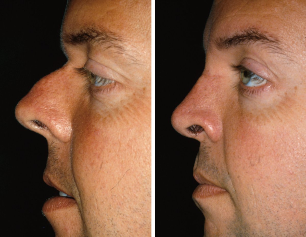 Resultados de rinoplastia antes y después en Cairo Plastic Clinic, remodelación nasal masculina