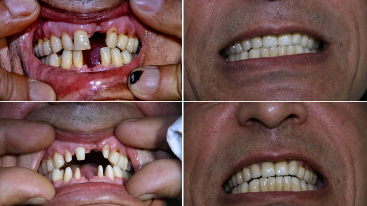 Before and after dental implant results at Smile Centrum – restored smile and missing teeth replaced