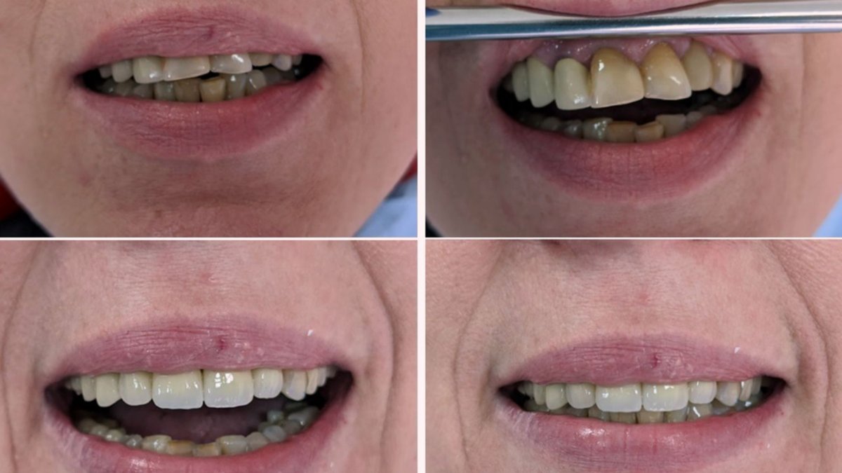 Результаты до и после протезирования в Smile Centrum – улучшенная улыбка и восстановление зубов