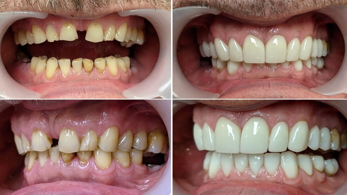 Результаты до и после протезирования в Smile Centrum – улучшенная улыбка и восстановление зубов