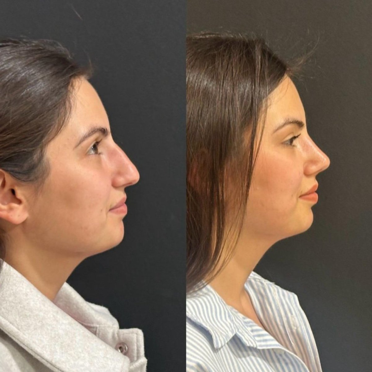 Résultats avant et après rhinoplastie au Medical Park Antalya Hospital Complex, remodelage du nez
