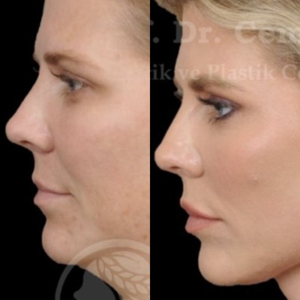 Resultados de lifting facial antes y después en Medical Park Antalya Hospital Complex, elevación visible
