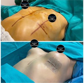 All-Inclusive Breast Augmentation