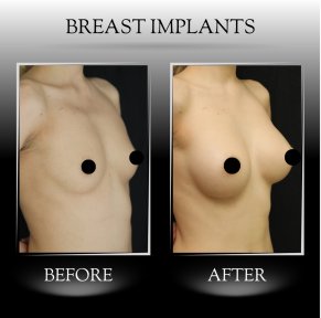 All-Inclusive Breast Augmentation - photo 3