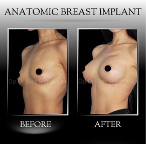 All-Inclusive Breast Augmentation - photo 2