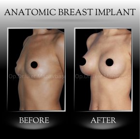 All-Inclusive Breast Augmentation - photo 5