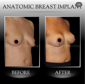 All-Inclusive Breast Augmentation - photo 4