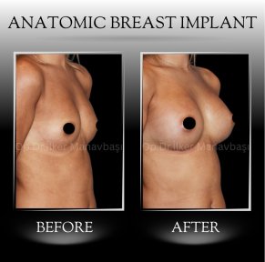 All-Inclusive Breast Augmentation - photo 6