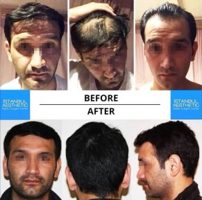 Package price for Hair Transplantation - photo 6
