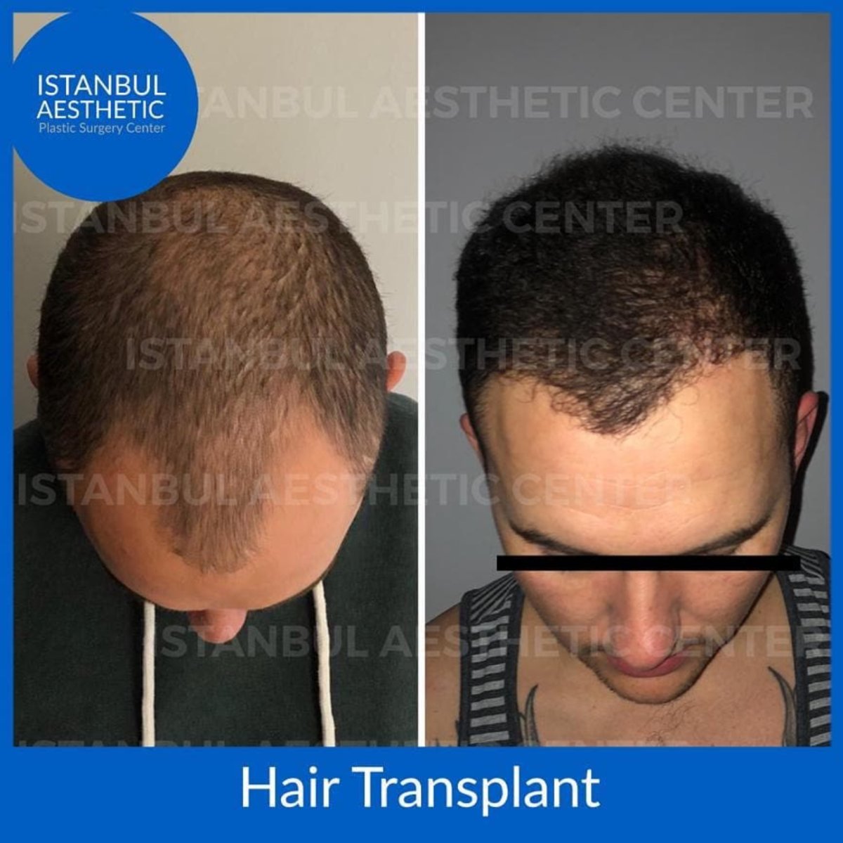 Efekty przeszczepu włosów przed i po w Istanbul Aesthetic Plastic Surgery Center, gęstsze włosy