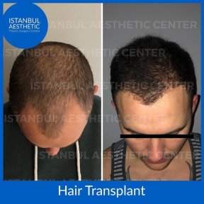 Package price for Hair Transplantation - photo 5