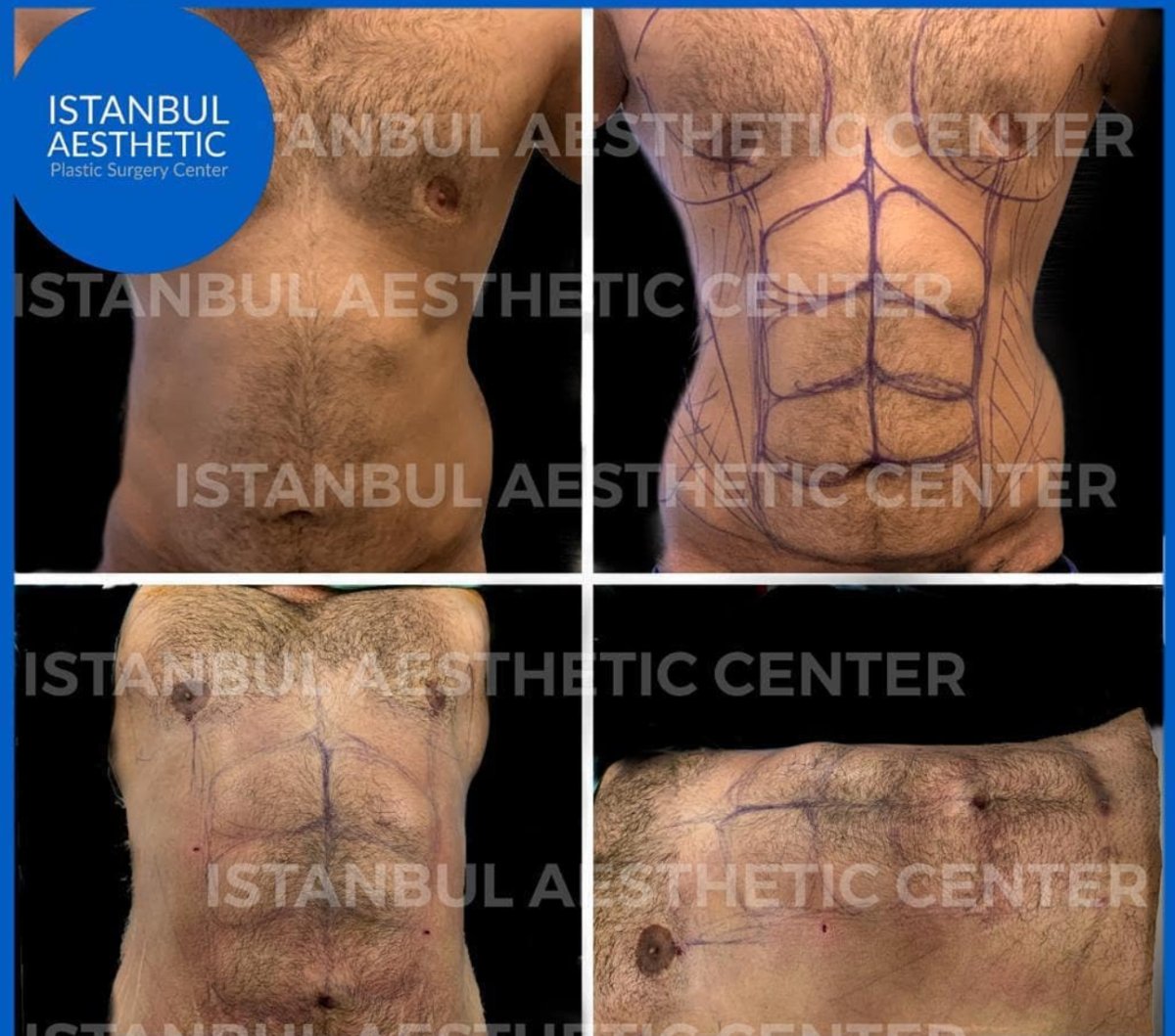 Resultados antes y después de Vaser lipo en Istanbul Aesthetic Plastic Surgery Center, abdomen masculino