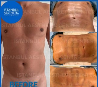 Vaser Liposuction 1 area