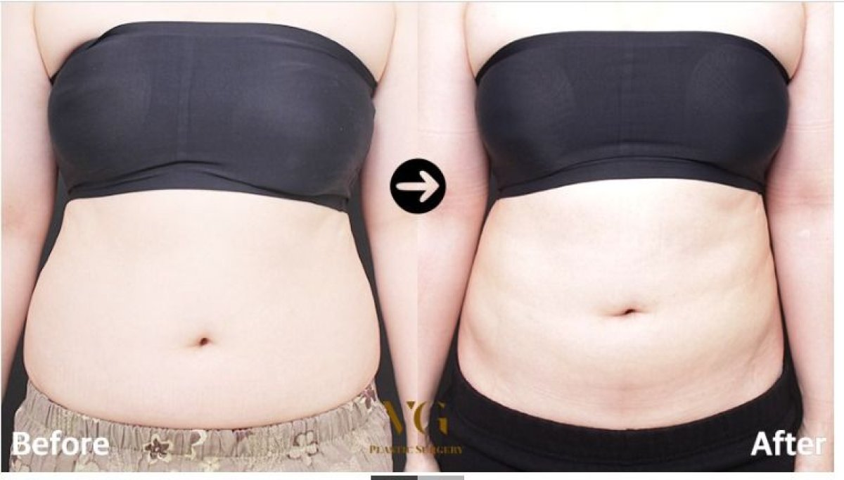 Résultats avant/après abdominoplastie et liposuccion chez VG Plastic Surgery, ventre plat